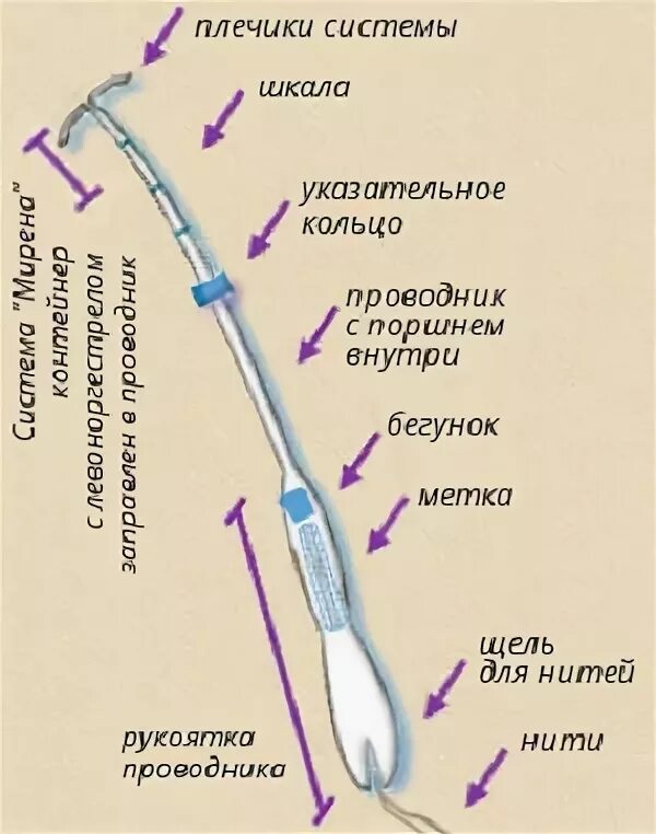 Введение вмс. Введение ВМС Мирена техника. Техника введения спирали Мирена. Техника введения внутриматочной рилизинг системы Мирена. Техника установки спирали Мирена.