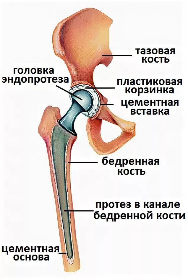 Эндопротез головки бедренной кости. Эндопротезирование тазобедренного сустава. Цементный эндопротез ТБС. Эндопротез тазобедренного сустава схема. После эндопротезирования шейки бедра