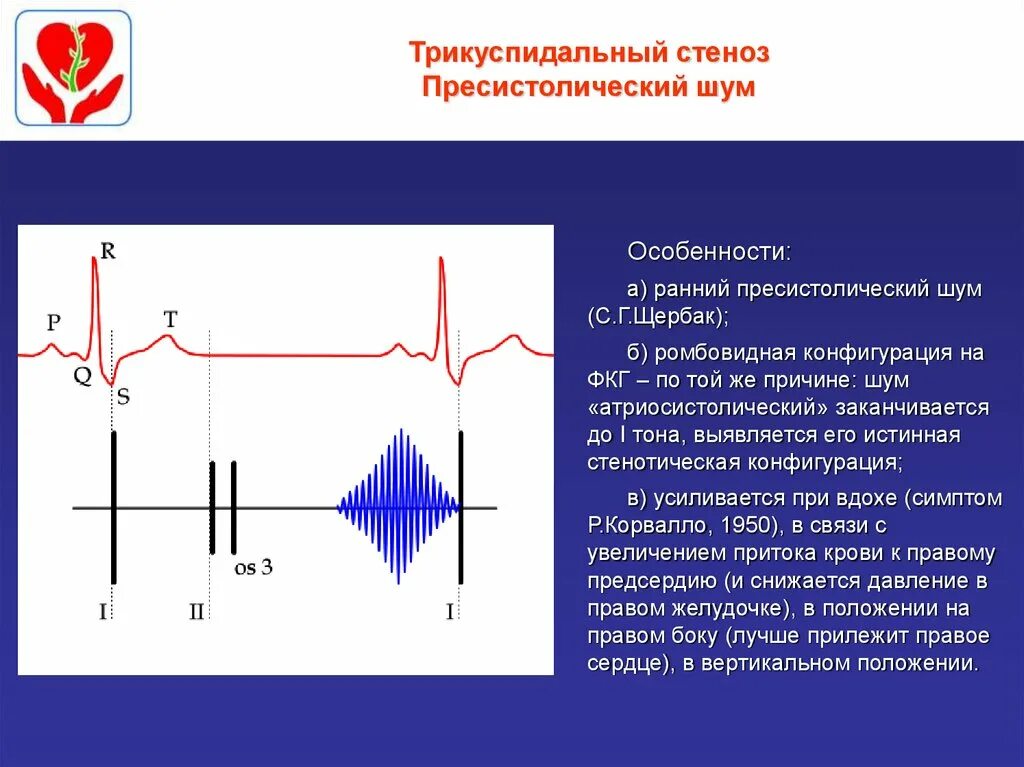 Сердечные тоны шумы. Стеноз трикуспидального клапана ЭКГ. Фонокардиограмма стеноз аортального клапана. Стеноз трехстворчатого клапана ЭКГ. ЭКГ при стенозе трикуспидального клапана.