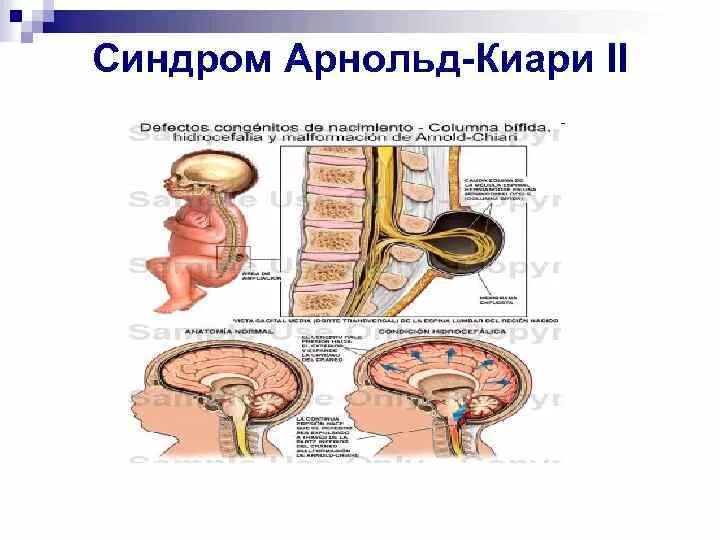 Синдром арнольда. Синдром арнольда киари новорожденных. синдром арнольда-киари 1 степени. синдром арнольда киари у младенца.