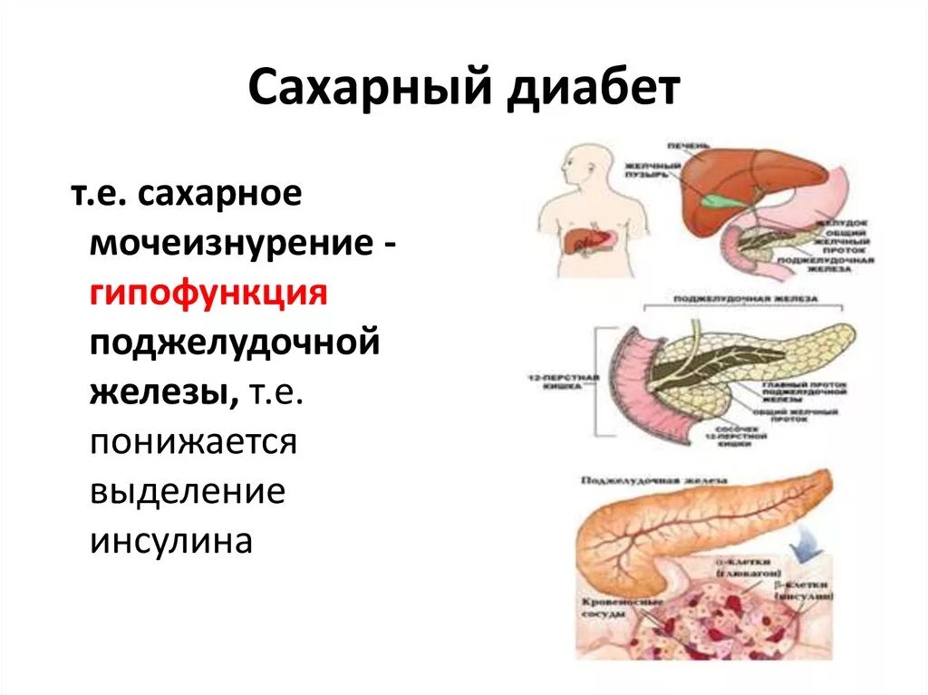 Поджелудочная железа диабет 1 типа. Поджелудочная железа с диабетом 2 типа. Сахарный диабет 1 типа поджелудочная железа. Схема поджелудочная железа инсулин.