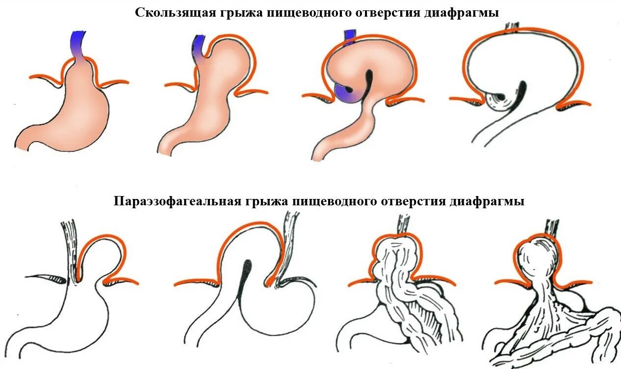 4 Типы грыж пищеводного отверстия диафрагмы. Аксиальная грыжа пищеводного отдела диафрагмы. Скользящая грыжа пищеводного отверстия диафрагмы операция. Грыжа пищеводного отверстия отверстия диафрагмы. Грыжа пищеводного отверстия причины