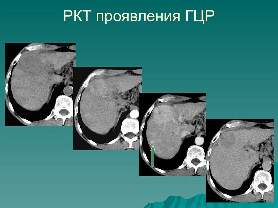 Ркт. Гепатоцеллюлярная карцинома кт. Гепатоцеллюлярная карцинома печени кт.