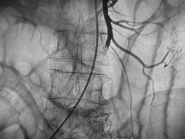 Мезентериальный тромбоз ангиография. Мезентериальная ишемия ангиография. Ангиография мезентериальных сосудов. Острая окклюзия мезентериальных сосудов. Тромбоз артерия и вена
