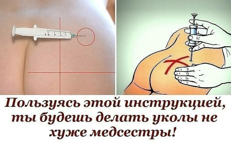 Как поставить укол в мышцу. Как правильно ставить укол внутримышечно. как правильно ставить уколы внутримышечно в ягодицу. как ставить укол в ягодицу в домашних условиях взрослому. как правильно делать уколы в ягодицу в домашних условиях самому.