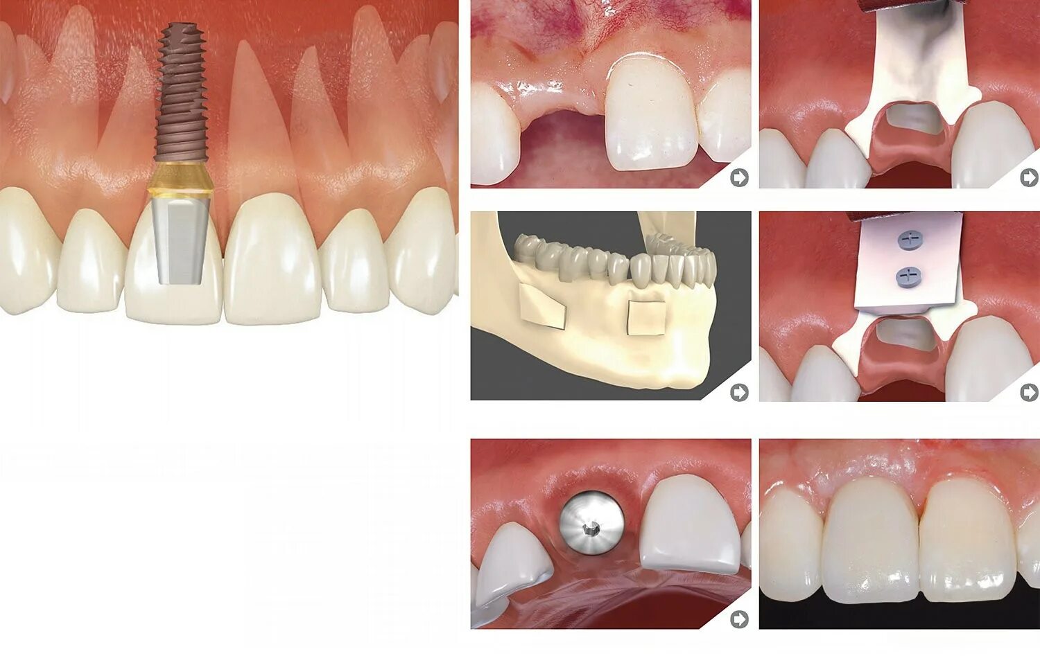 направленная костная регенерация в стоматологии. имплантация зубов без костной пластики. аугментация гайморовой пазухи. имплантация зубов dental implan. протезирование костной ткани.