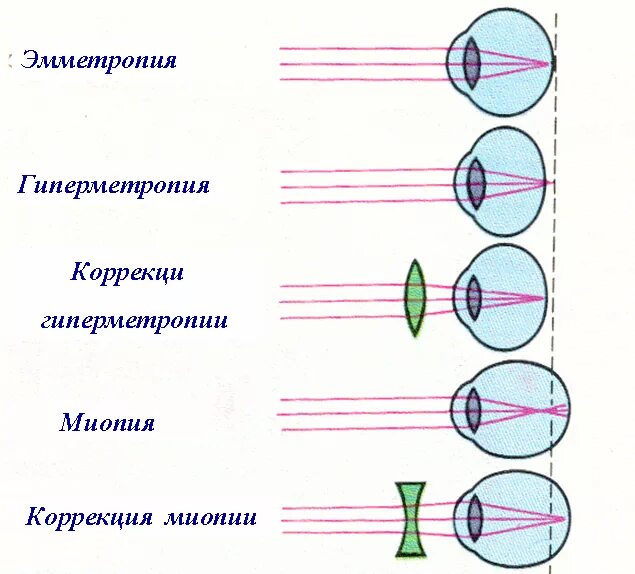 Нормальный глаз схема. Схемы рефракции при нормальном зрении. Схема рефракции в близоруком глазу. Схема близорукости и дальнозоркости и нормального глаза. Дальнозоркость близорукость оптическая схема.