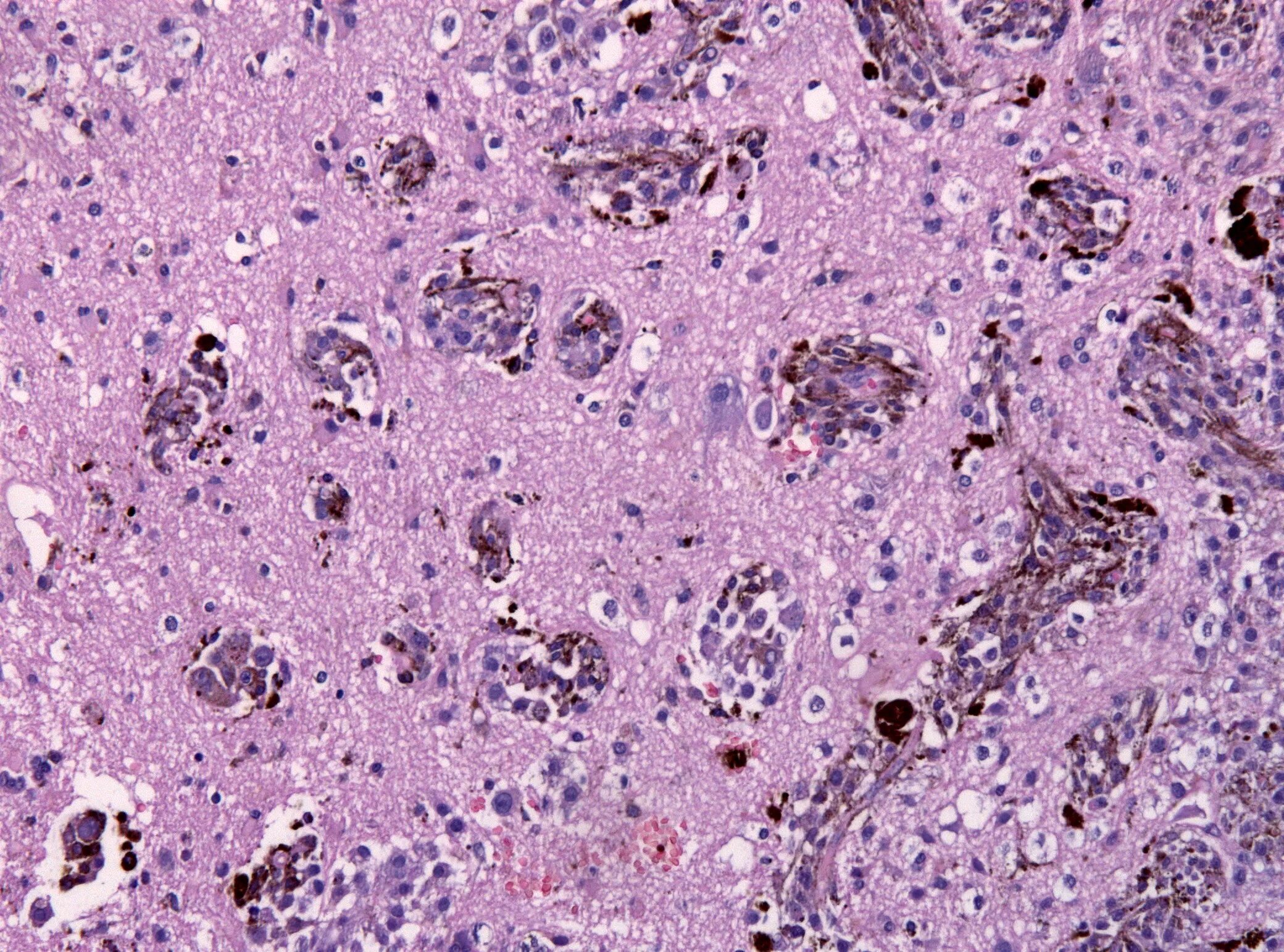 Меланома метастазы в мозг. Меланома кожи под микроскопом. Полиморфноклеточная меланома. Метастазы под микроскопом.