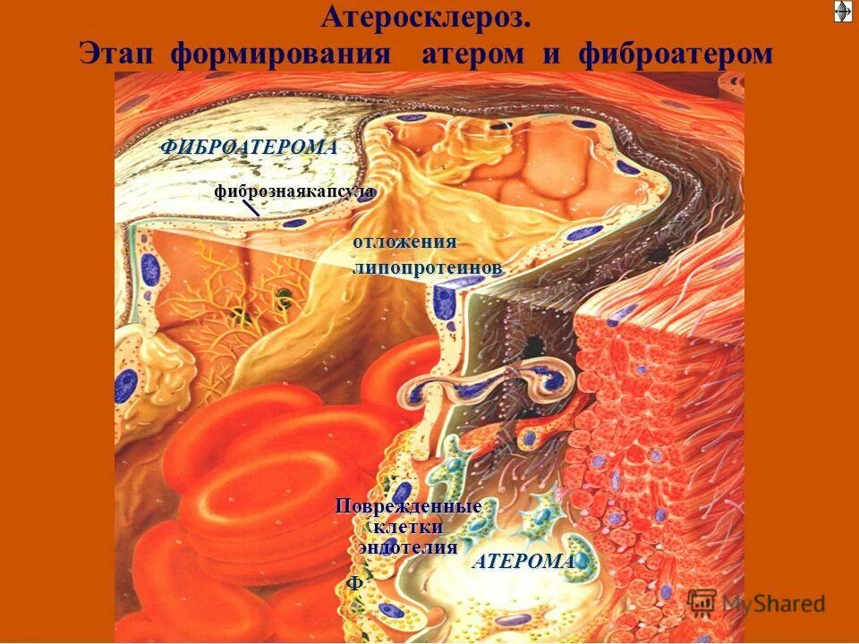 Долипидная стадия атеросклероза. Морфогенетический механизм развития атеросклероза. Морфогенетический механизм развития атеросклероза. Стадии формирования атеросклероза. Схема формирования атеросклеротической бляшки.