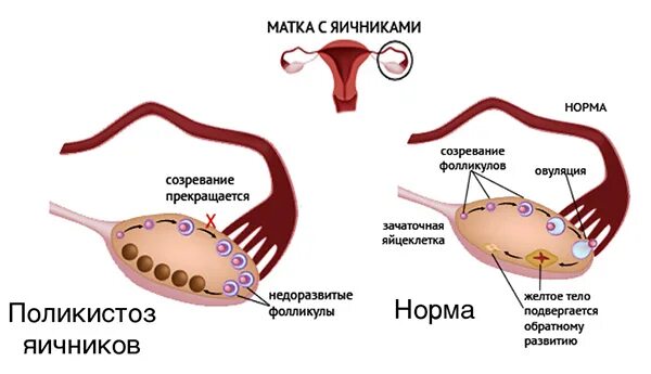 Стимулирование овуляции при поликистозе. Болят яичники стимуляция