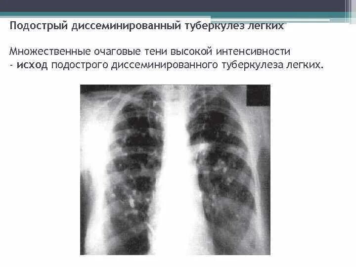 Очаговые тени не определяются. Очаговый туберкулёз лёгких рентген. Очаговые тени не определяются. Очаговые тени не определяются. Очаговый туберкулез рентген.