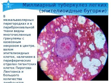 Туберкулез клетка