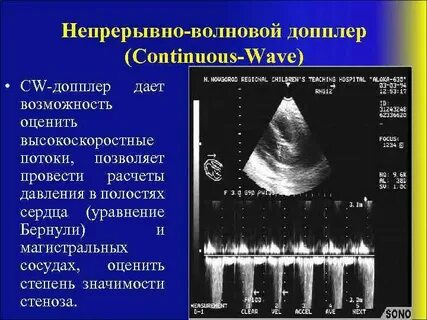 Волновой доплер