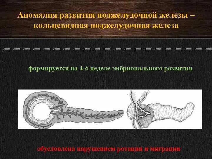 Аномалии развития поджелудочной железы. Врожденные аномалии поджелудочной железы. Аберрантная поджелудочная железа. Аберрантная поджелудочная железа кт.