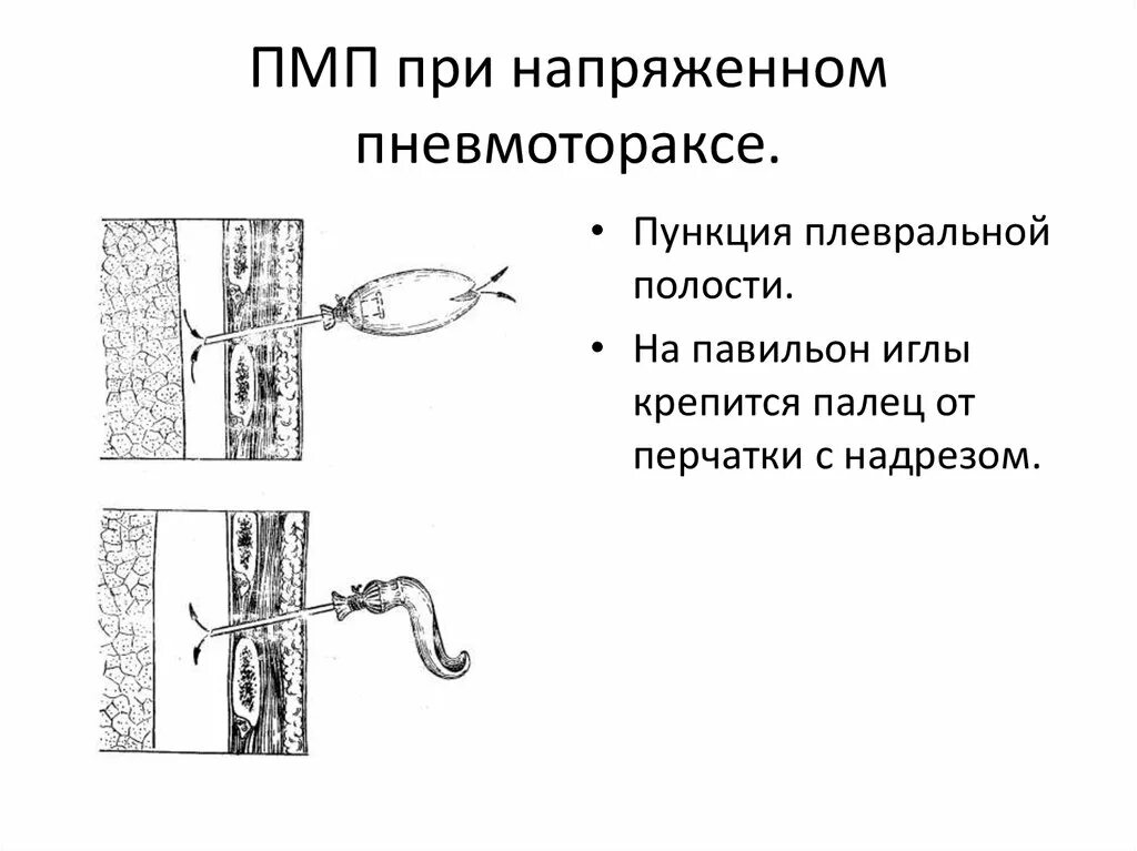 Напряженный пневмоторакс помощь