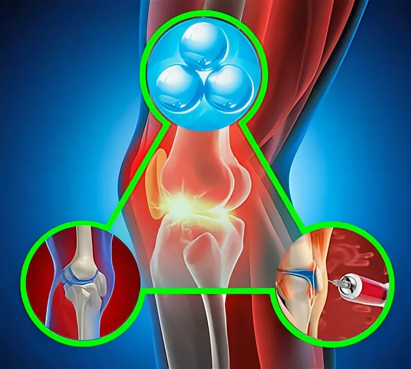 Озонотерапия для суставов. Озоновая терапия суставов. Озон терапия коленного сустава. Азон терепия коленого состава.