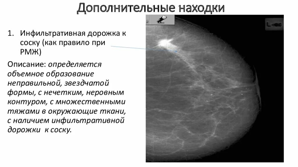 Округлые образования в молочной железе