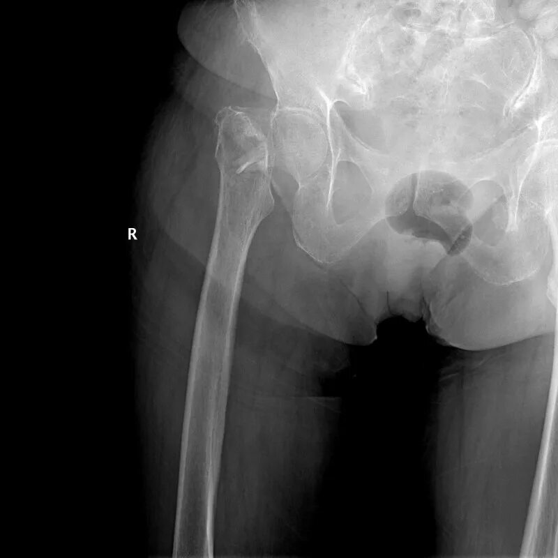 Симптомы шейка бедра у женщины. Вколоченный перелом шейки бедра рентген. Вколоченный перелом рентген. Вколоченный перелом шейки бедра. Несросшийся перелом шейки бедра.
