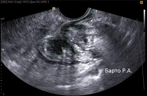 Эхо признаки эндометриоза