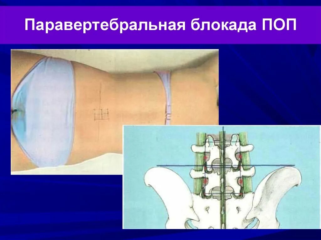 Блокада техника выполнения. Паравертебральная блокада поясничного отдела позвоночника. Блокада корешка l5-s1 техника. Блокада корешковая паравертебральная. Методика паравертебральной блокады.