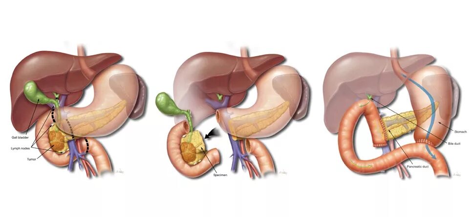 Панкреатит при удаленном желчном. Операция Уиппла на поджелудочной железе. Операция Уиппла (панкреатодуоденальная резекция). Резекция головки поджелудочной железы.