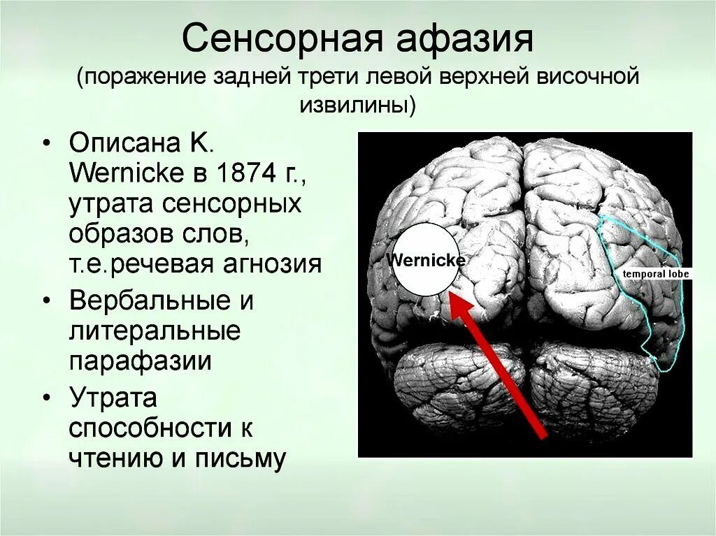 Зона Брока и Вернике афазия. Афазия сенсорная моторная динамическая. Моторная афазия сенсорная афазия амнестическая. Задняя треть верхней височной извилины.