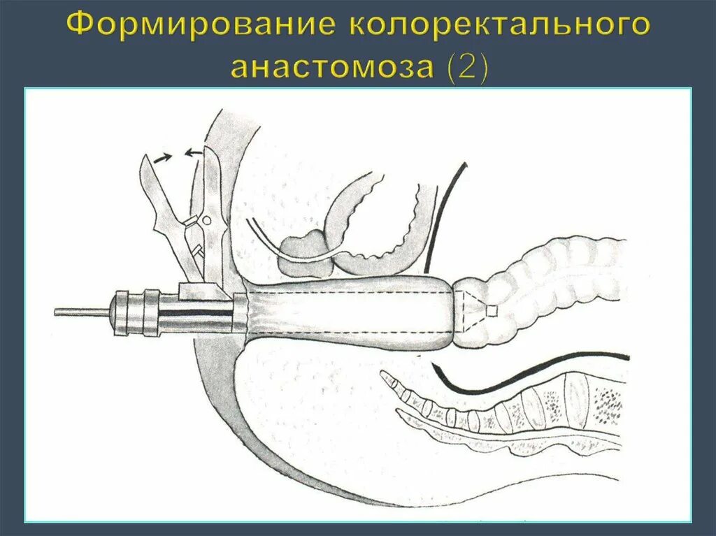 Ректальные операции. Формирование анастомоза. Колоректального анастомоза. Наложение колоректального анастомоза.