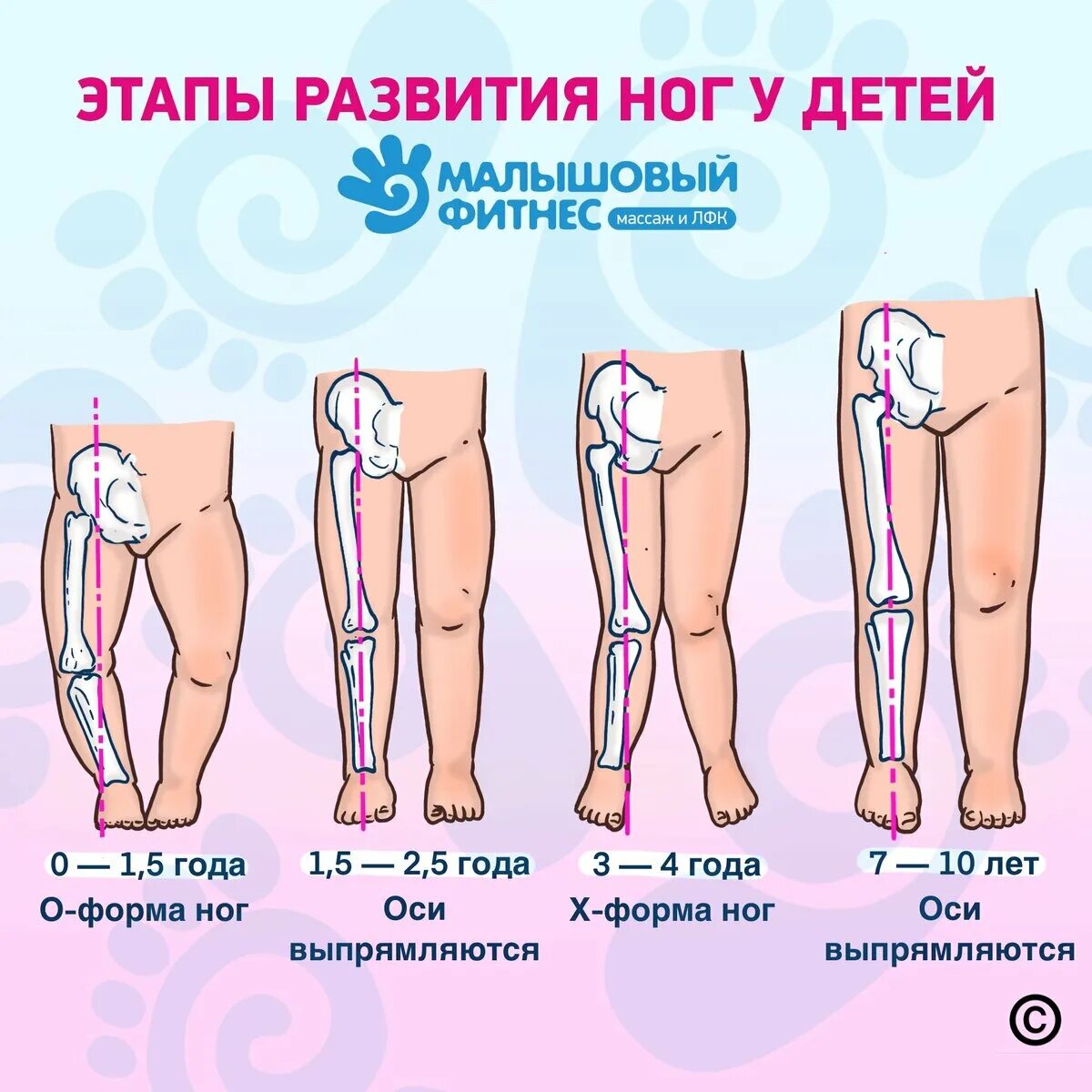 Деформация ног ребенка. Деформация ног ребенка