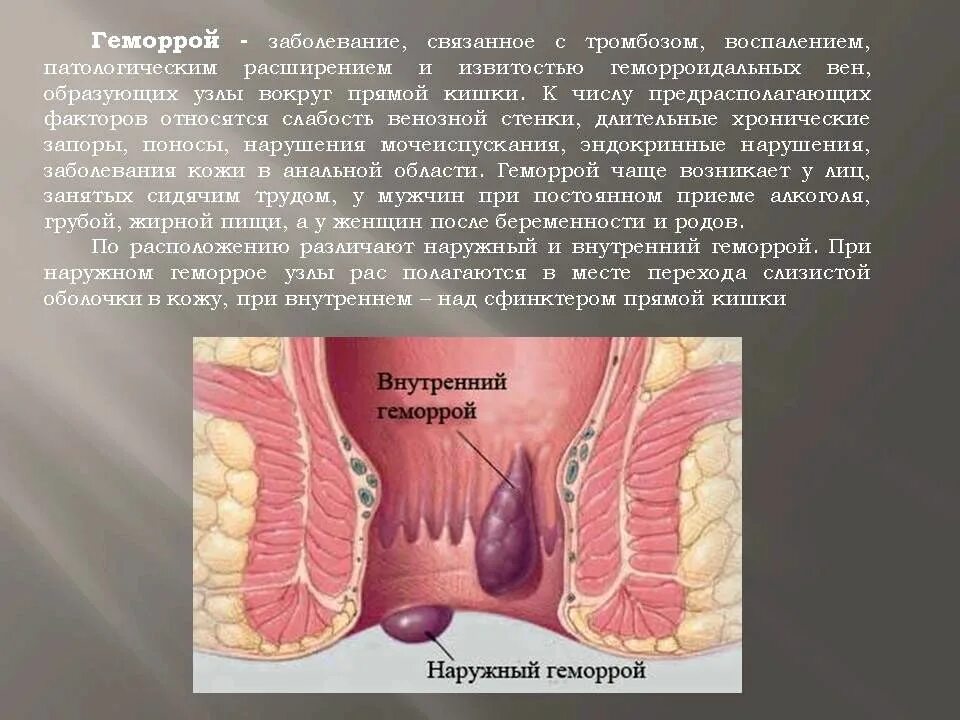 Боли внутри заднего прохода