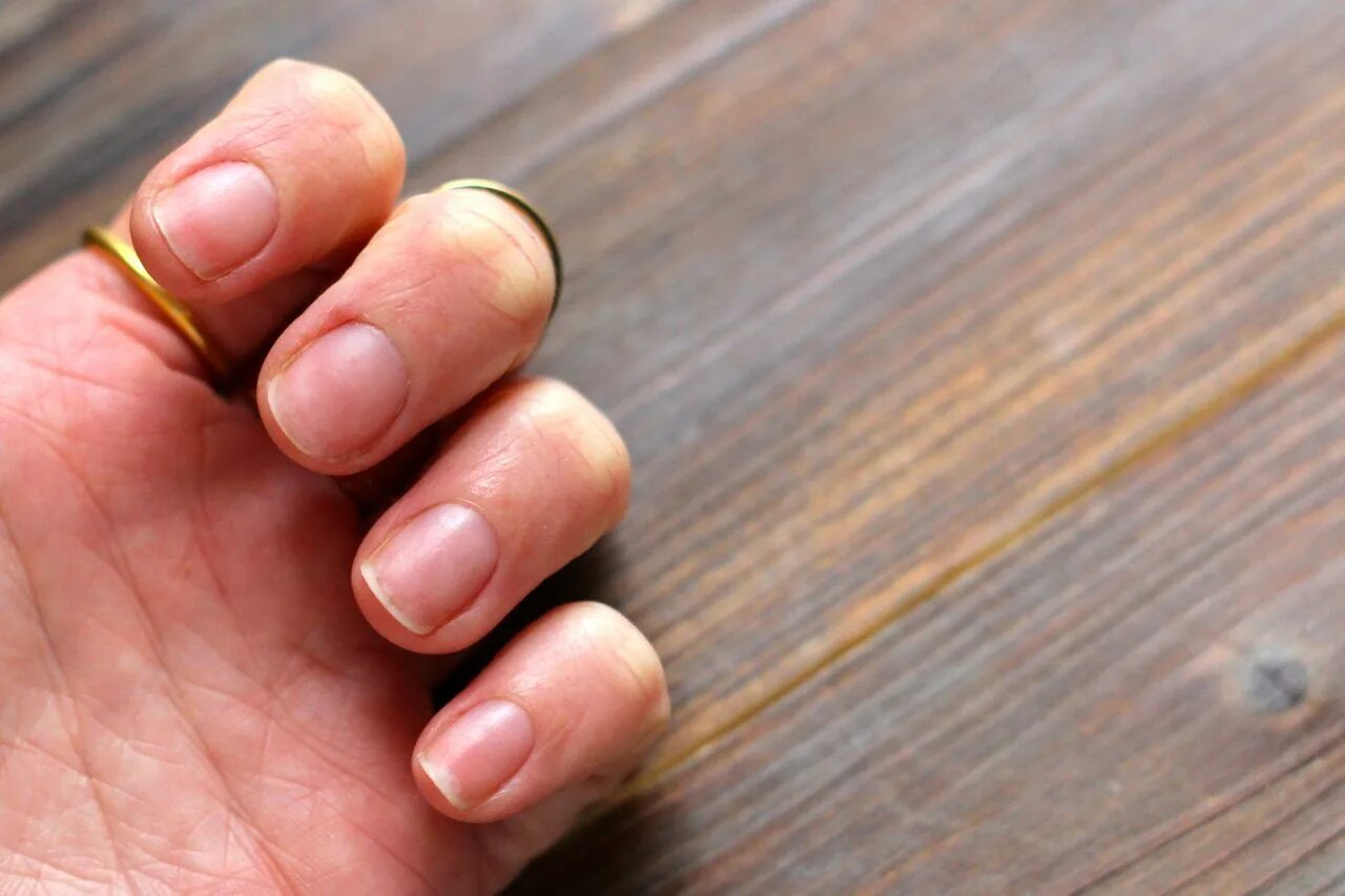 ногти на руках загибаются вверх