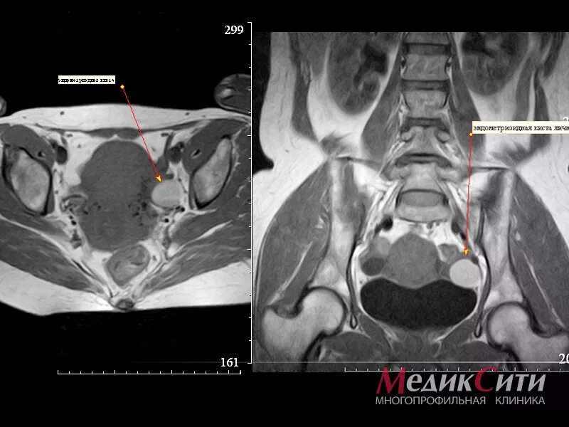 У мужчина киста будет. Мрт ОМТ. Мрт ОМТ малого таза. Мрт анатомия малого таза. Мрт малого таза у женщин.