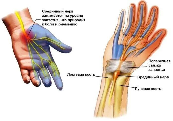 Невропатия нерва руки. Нейропатия локтевого нерва клиника. Туннельные нейропатии локтевой нерв. Нейропатия срединного нерва. Сенсорная нейропатия локтевого нерва.