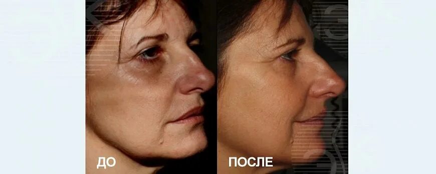 Массаж лица до и после. Лпджи лица до и после. Lpg лица до и после. Буккальный массаж лица эффект до и после. Lpg лица до и после.