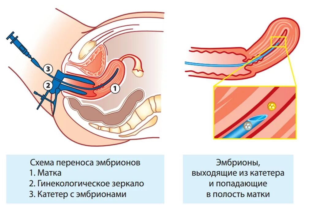 Почему подсаживают. Катетер для подсадки эмбриона в полость матки. Перенос эмбрионов (ПЭ) В полость матки (трансфер эмбрионов). Катетер при переносе эмбрионов. Катетер для переноса эмбрионов в полость матки.