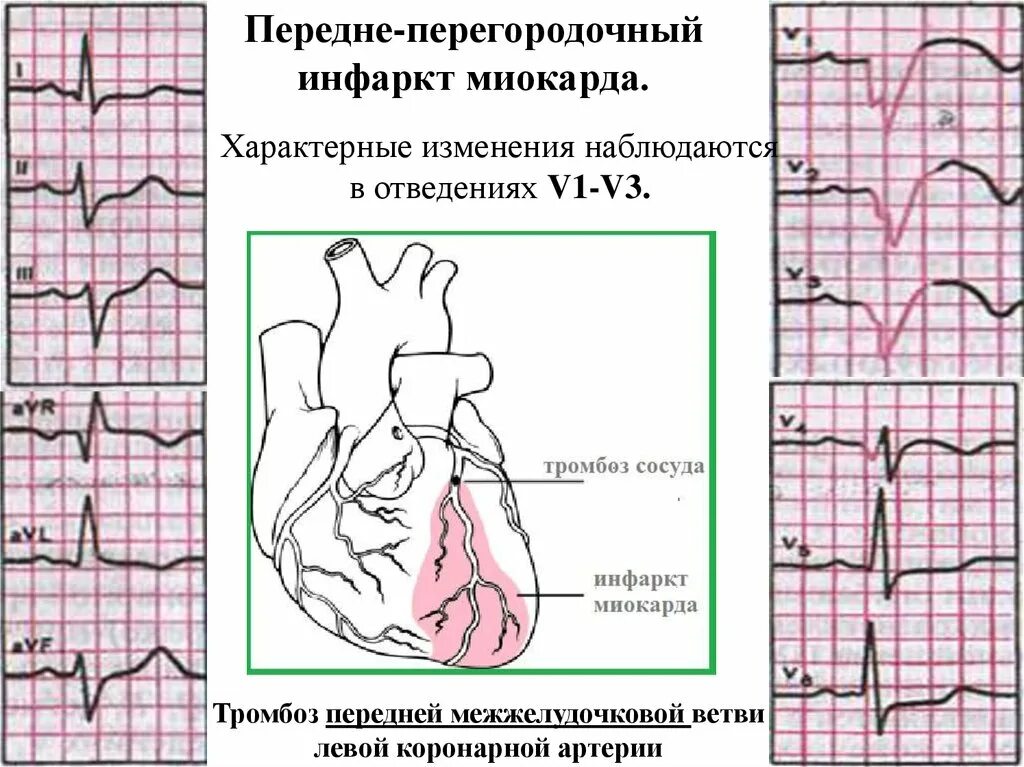 Передне-перегородочный инфаркт миокарда. Острый передне перегородочный инфаркт ЭКГ. Септальный инфаркт миокарда на ЭКГ. Инфаркт миокарда боковой стенки на ЭКГ. Очаговые изменения желудочка