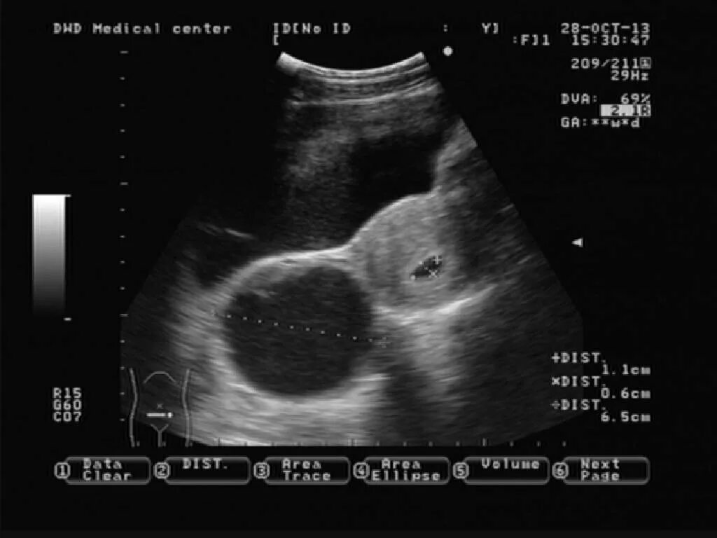 Киста желтого тела на УЗИ при беременности. Киста и беременность на УЗИ. Яичниковая беременность на УЗИ. Можно ли спутать кисту