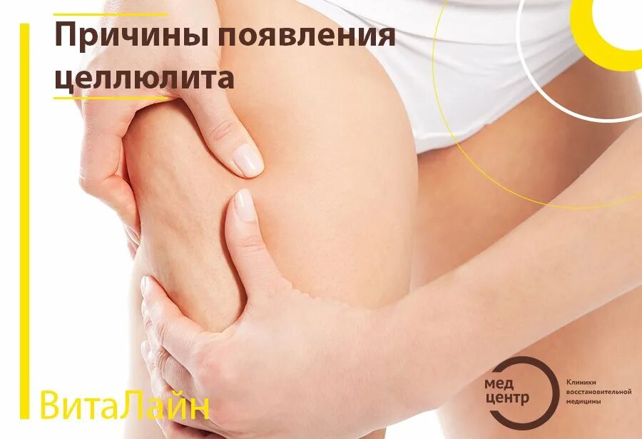 Почему появляется целлюлит. Причины появления целлюлита. целлюлит причины возникновения. гормональные факторы появления целлюлита.