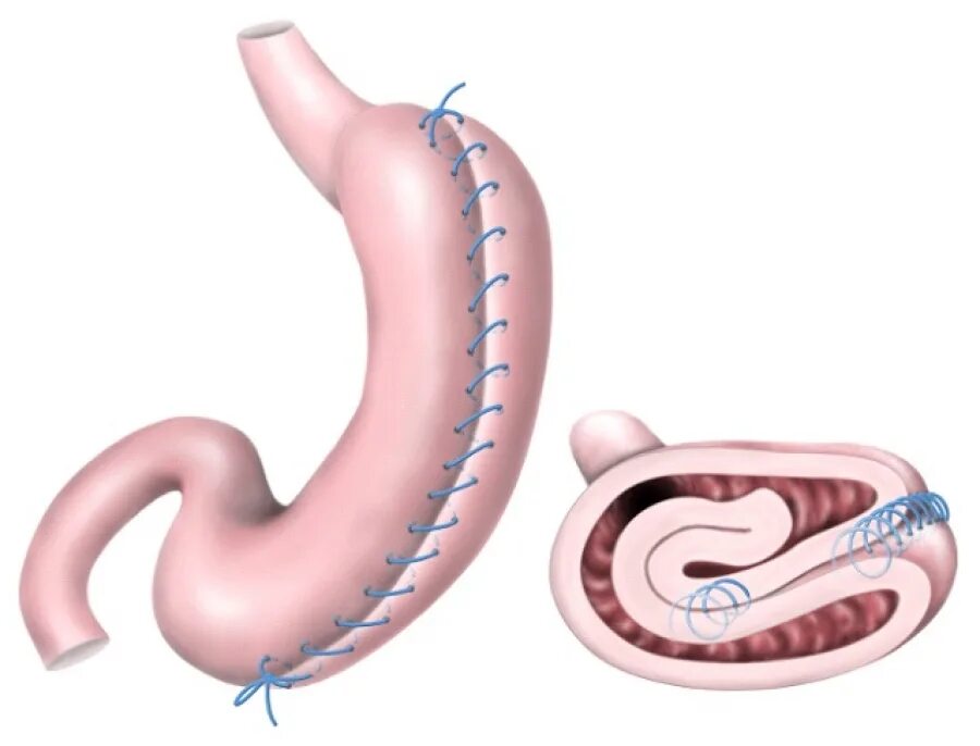 Ушивание желудка (гастропликация). Бариатрическая хирургия резекция желудка. Гастропликация лапароскопическая желудка что это. Бариатрическая хирургия это