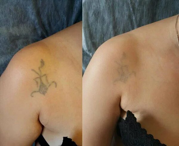 Рубцы после сведения тату. После сведения тату остается шрам. Шрам после сведения тату лазером. Сведение тату до и после. После сведения тату остается шрам.