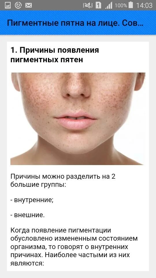 Лентиго, хлоазма, веснушки. Эпидермальная мелазма. Причины пигментации. Пигментниепятни на лице. Хлоазма (мелазма) на теле.