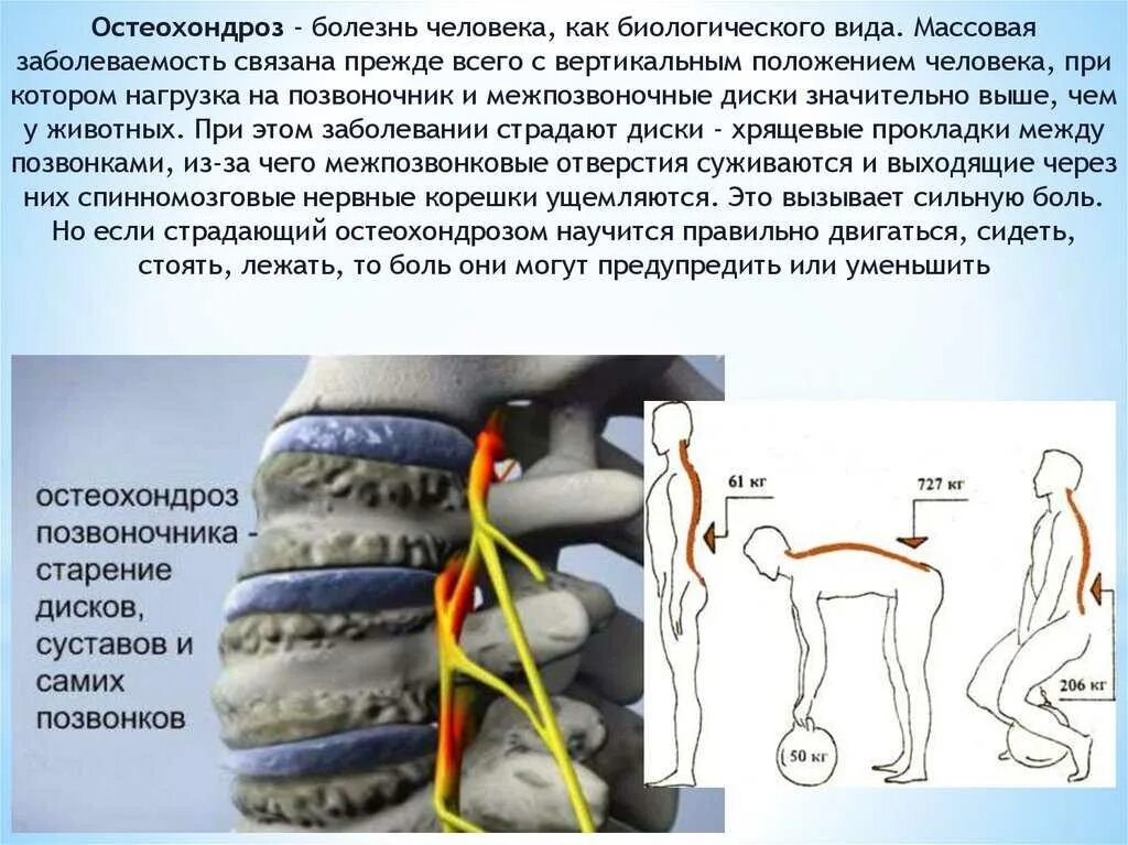 Лечение острого остеохондроза. Остеохондроз. Остеохондроз позвоночника. Нагрузка на позвоночник. Заболевания позвоночника остеохондроз.