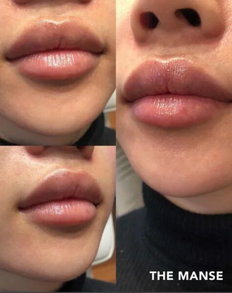Препарат сардиния для губ отзывы. Сардиния филлер для губ 1 мл до и после. Сардиния филлер для губ до после. Препараты для увеличения губ.