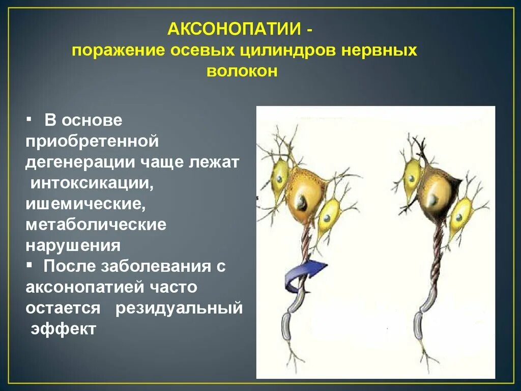 Аксональное поражение сенсорных нервов. Аксонопатии. Аксональная дегенерация. Дегенерация нервных волокон. Дегенерация и регенерация нервных волокон.