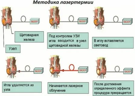 Операция на узлы щитовидной железы