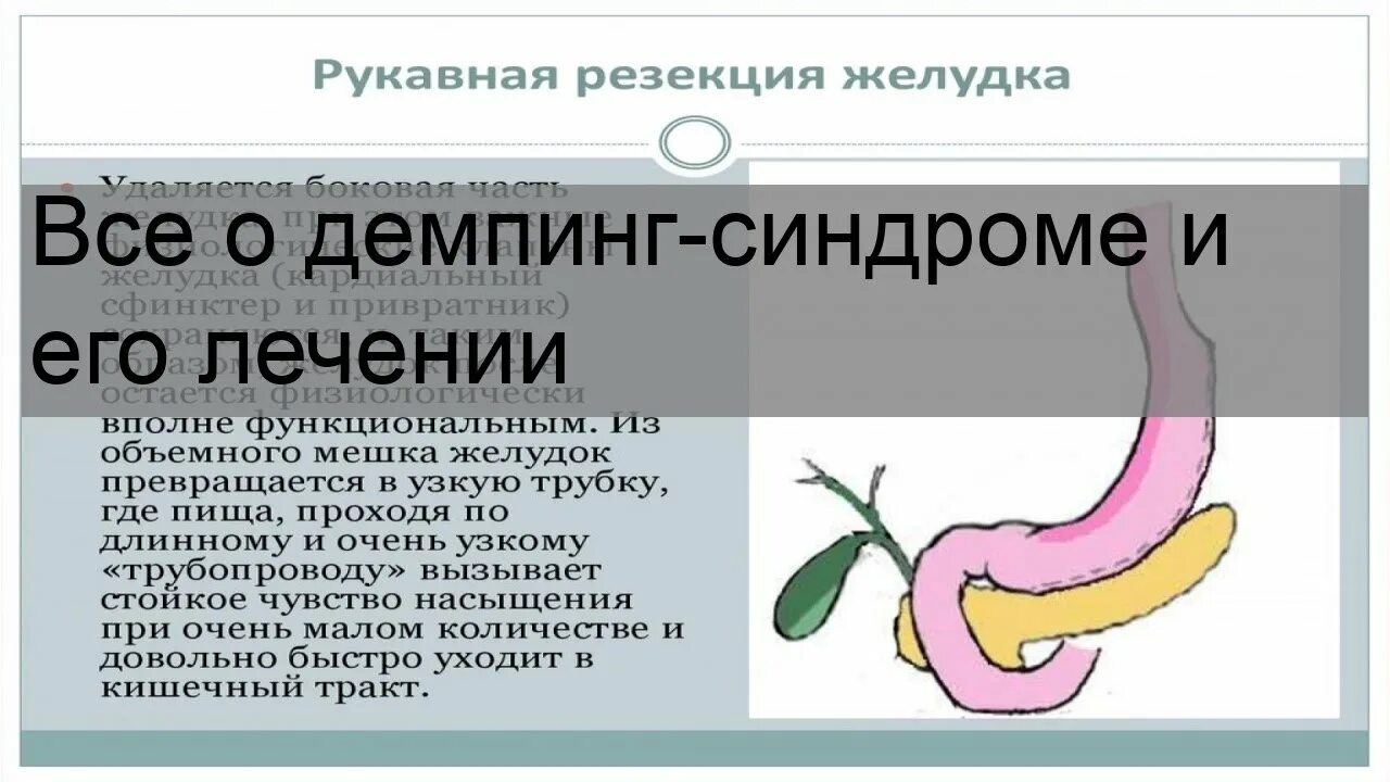Демпинг синдром после резекции желудка. Демпинг синдром бильрот 1. демпинг синдром после резекции. демпинг синдром рентген. демпинг при бариатрических операциях.