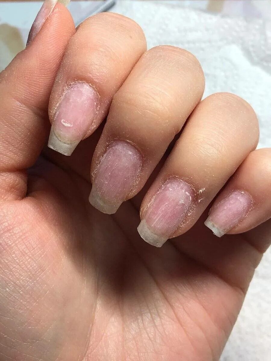 Почему после наращивания ногтей. Гиперкератотический онихолизис. Ногти после нарощенных ногтей. Ногти после наращивания.