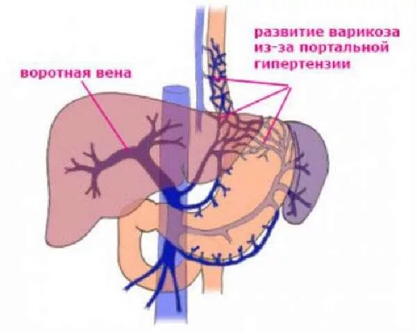 Синдром портальной гипертензии печени. Пресинусоидальная портальная гипертензия. Портальная гипертензия варикозное расширение вен пищевода. Синдром воротная Вена. Печень расширены вены