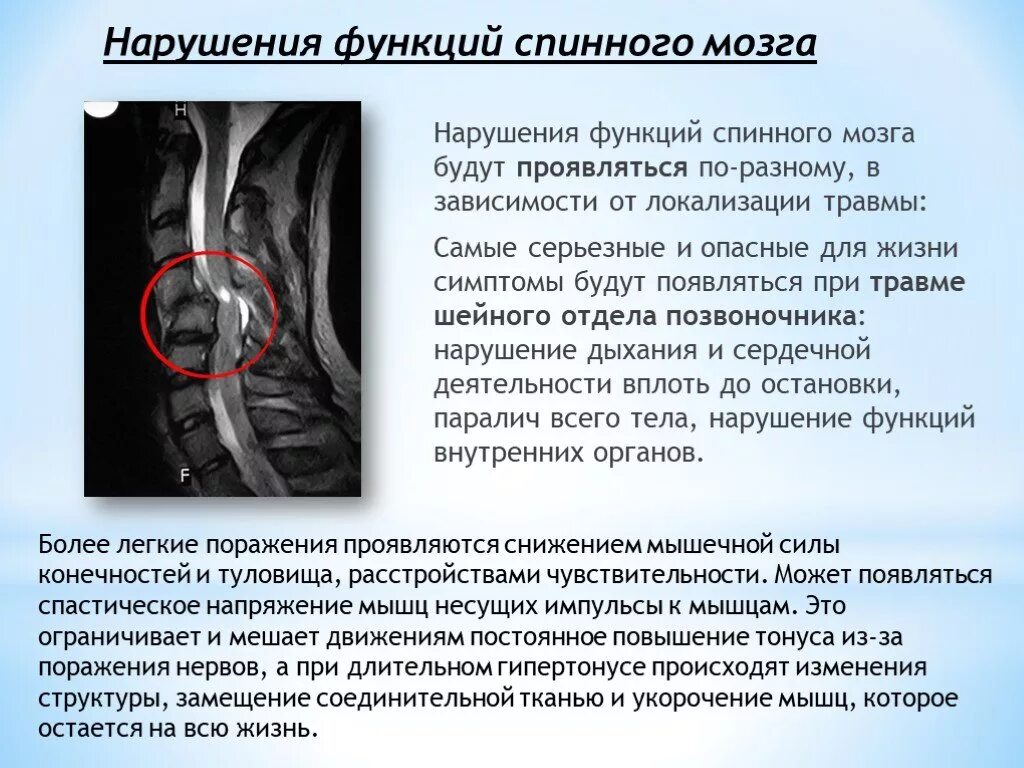 Спинальный инсульт что это симптомы и лечение. Нарушение функций при повреждении спинного мозга. Травма позвоночника с повреждением спинного мозга. Травма шейного отдела спинного мозга. Повреждение спинного мозга последствия.