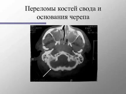 Перелом основной кости