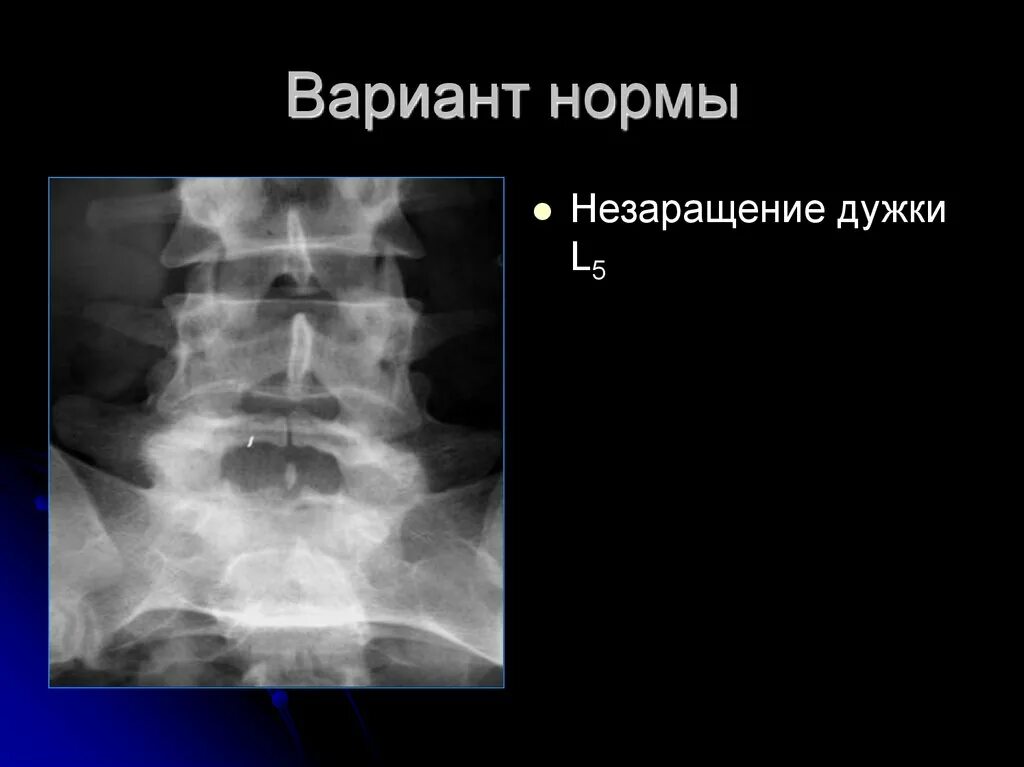 Незаращение дужки позвонка. Незаращение задней дуги l5 позвонка. незаращение задней дуги s1 позвонка. незаращение дужки l5 позвонка рентген. незаращение задней дуги s1 рентген.